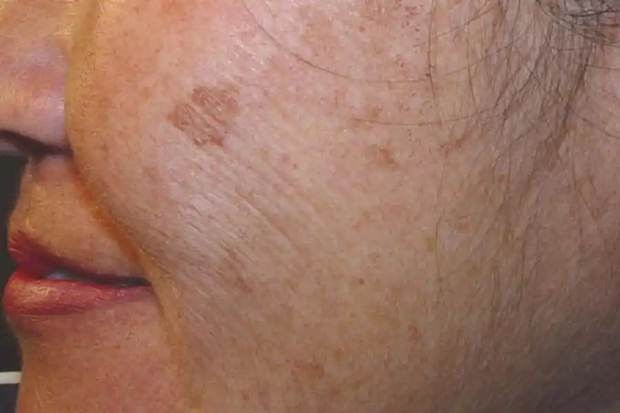 Las manchas marrones en la piel son signo de la pérdida de colágeno.
