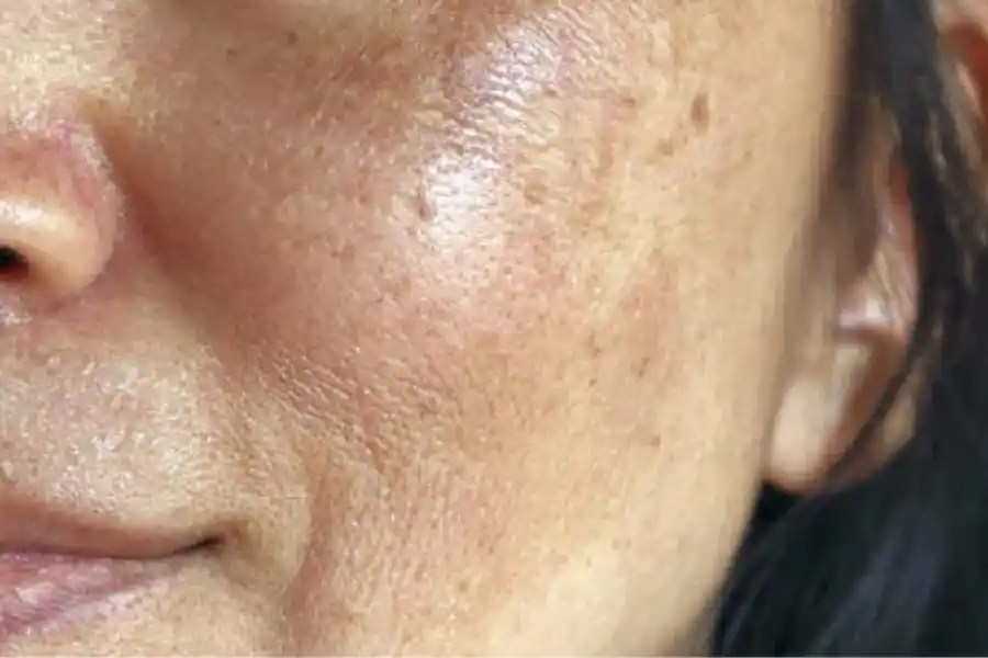 Día Mundial del Cuidado de la Piel: cómo usar el aceite de oliva para quitar las manchas