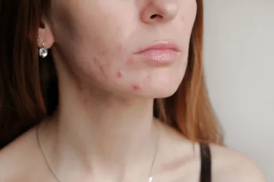 ¿Por qué me sale acné en la adultez? La causa de los brotes pasada la adolescencia