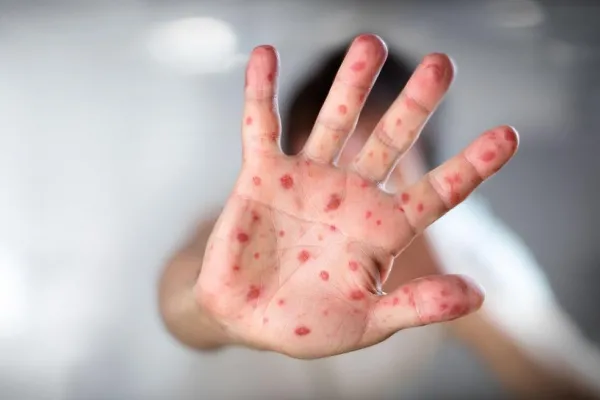Viruela del mono: detectaron siete nuevos casos en Argentina