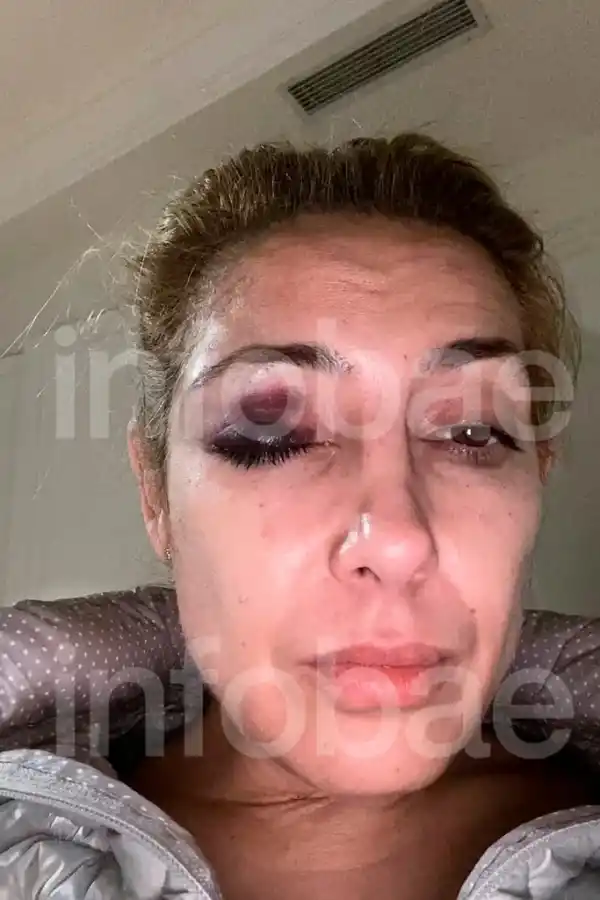Las nuevas fotos que aportó la querella donde se ve a Fabiola Yáñez con moretones en la cara