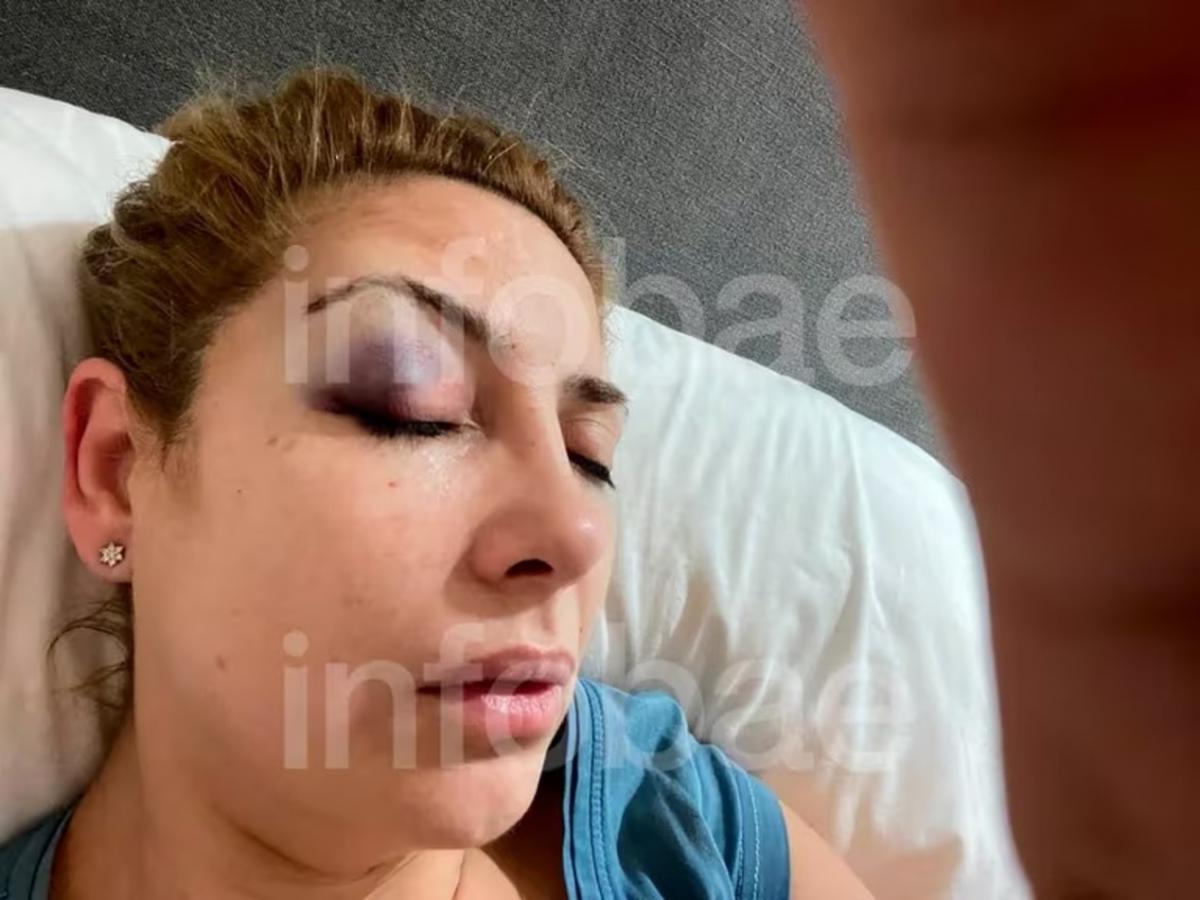 Las nuevas fotos que aportó la querella donde se ve a Fabiola Yáñez con moretones en la cara