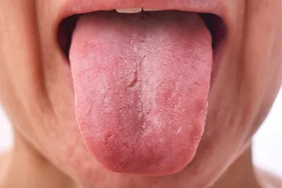 Cómo es una lengua sana y qué señales podrían indicar problemas de salud