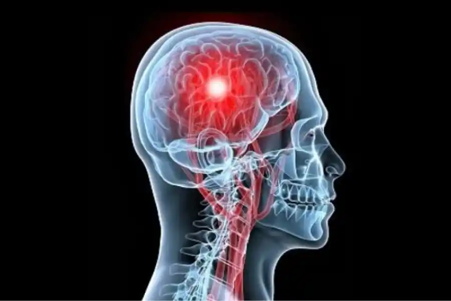 El accidente cerebro vascular se produce en las distintas partes del encéfalo.