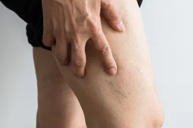 Conocé cuál es el origen de las arañitas en las piernas y cómo podés tratarlas