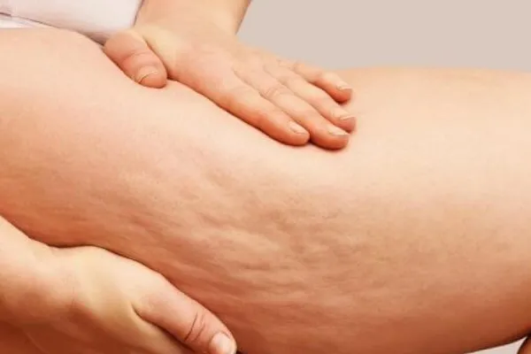 No son “piernas gordas”, es lipedema: de qué trata la enfermedad que afecta a muchas mujeres