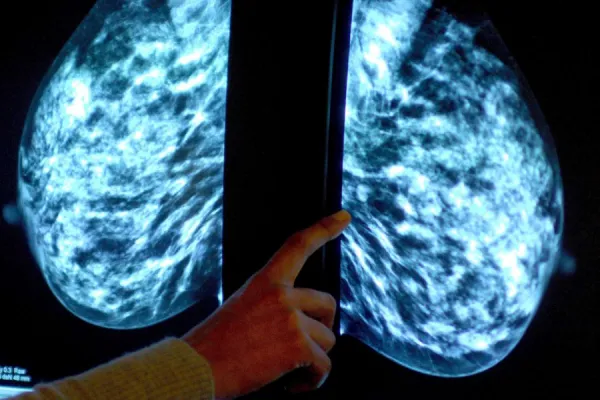 Cinco datos que tenés que saber sobre el cáncer de mama