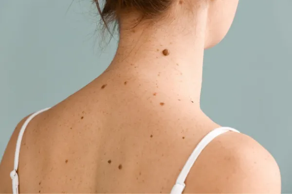 ¿Tenés muchos lunares? Cuidado con la exposición al sol porque podría producir cáncer