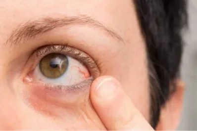 Atención a esta manchita en el ojo: podría ser señal de melanoma ocular