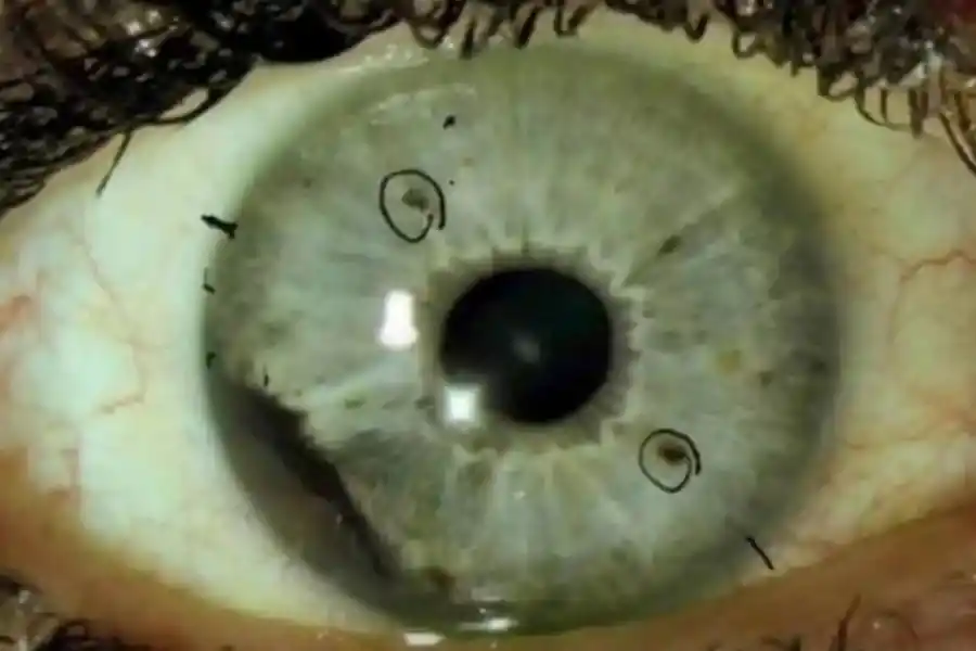 Melanoma ocular, el raro cáncer de ojo que está arrasando en Estados Unidos.