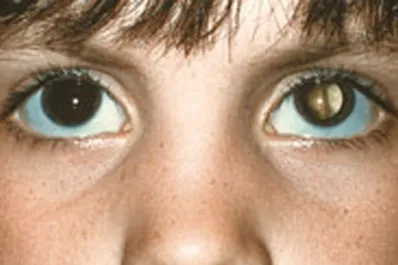 Rojos, blancos o amarillos: ¿por qué debemos prestar atención a los colores de los ojos en las fotos?