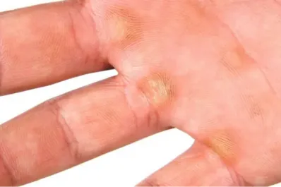 ¿Por qué los callos en la piel son un beneficio para la salud?