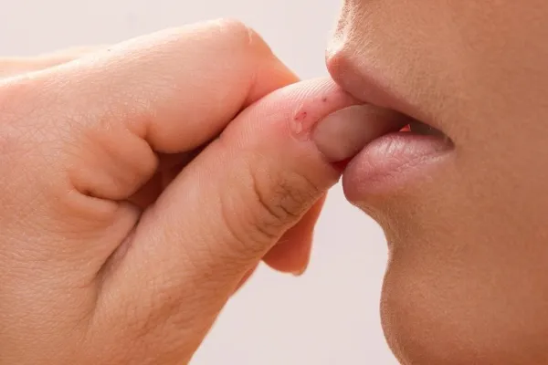 Cuáles son los síntomas de la sepsis, la mortal infección que se origina por morderse las uñas