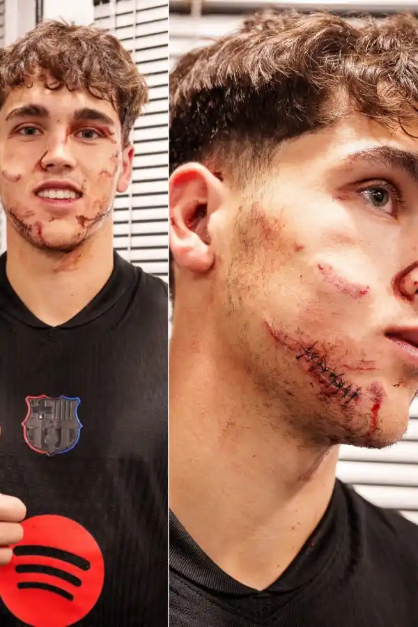 Así quedó el rostro de Pau Cubarsi, tras la patada que recibió contra Estrella de Belgrado.
