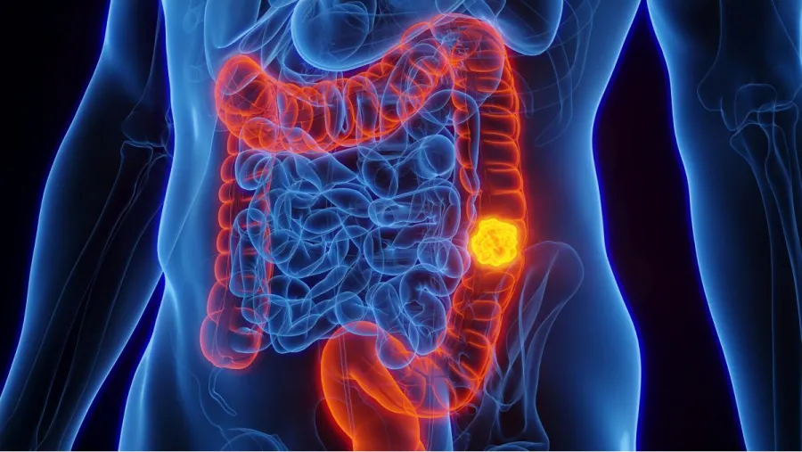 El cáncer de colon es cada vez más frecuente en jóvenes