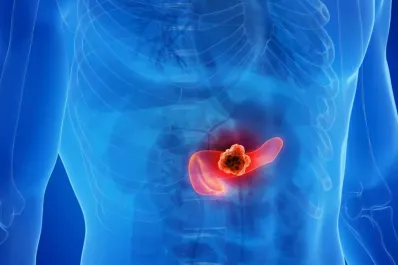 Cáncer de páncreas: estos son los primeros síntomas que no debes ignorar