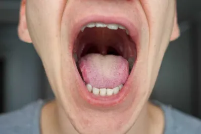 Los indicadores del cáncer de boca: la enfermedad que produce dos muertes por día