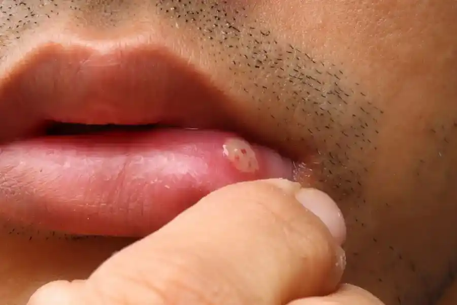 Las marcas en la boca como aftas o ampollas persistentes pueden ser una señal de alerta.