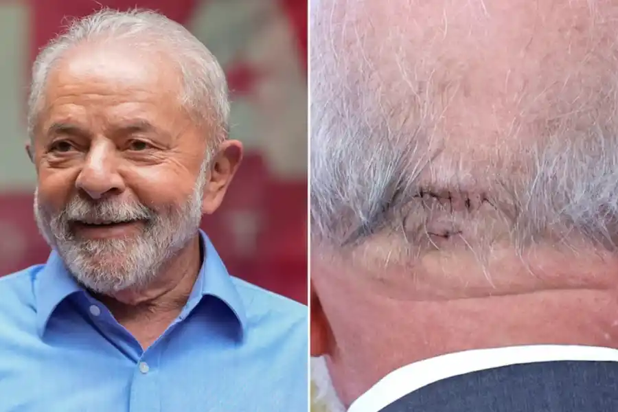 En Brasil, Lula da Silva fue operado de emergencia por una hemorragia intracraneal