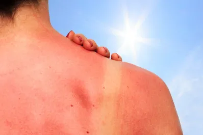 No es protector solar: los trucos para cuidar la piel del sol en verano