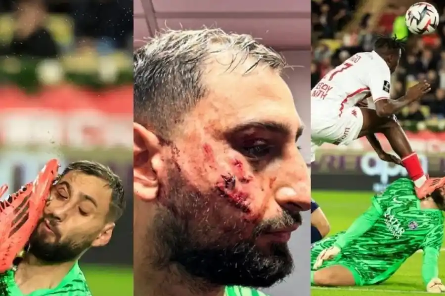 Le cerraron la herida con una abrochadora: las impactantes imágenes del rostro de Donnarumma tras recibir un planchazo