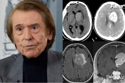 La salud de Raphael: qué es el linfoma cerebral, cuáles son sus principales síntomas y cómo se trata