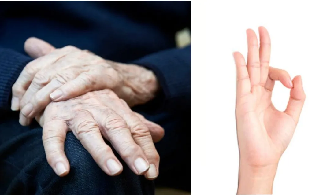 El índice y el pulgar suelen unirse y tener movimientos similares a los que se hacen al rascar o intentar limpiar migas de los dedos.