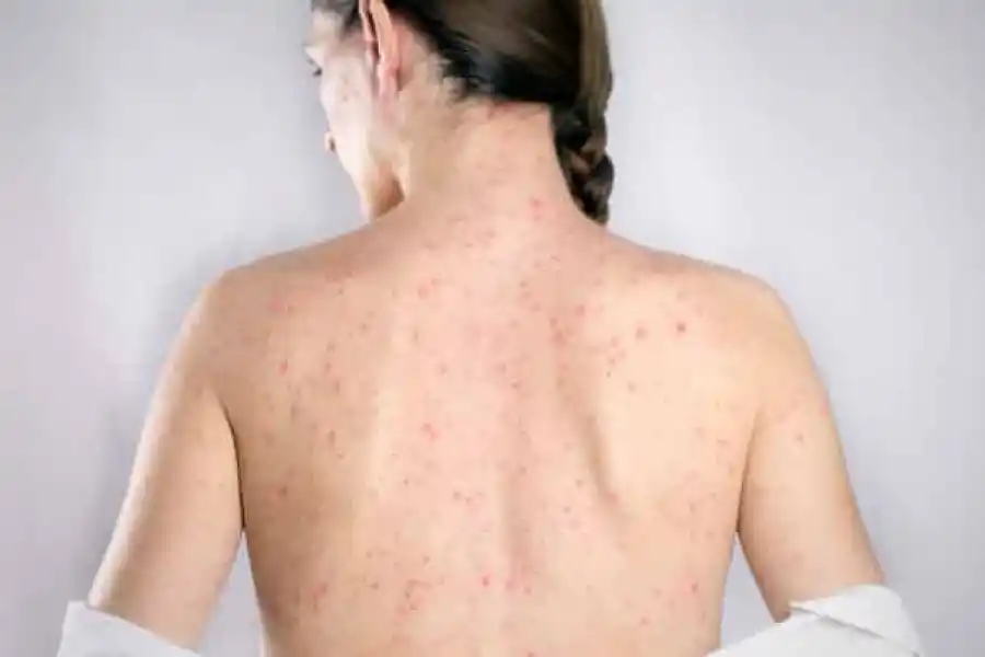 Sífilis: los síntomas de una enfermedad que puede ser silenciosa