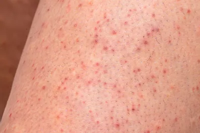 Queratosis pilaris: por qué se produce y cómo solucionar la afección de piel de fresa