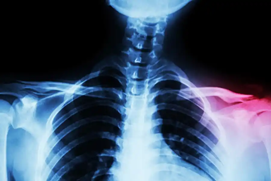 Una fractura de clavícula se diagnostica mediante un examen físico y radiografías.