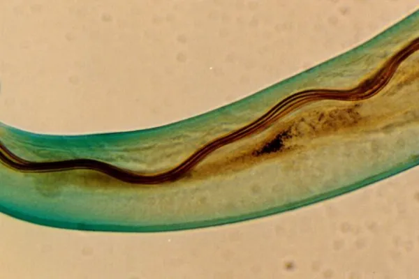 Llegó al hospital por un intenso ardor de pies y descubrieron que tenía gusanos en el cerebro