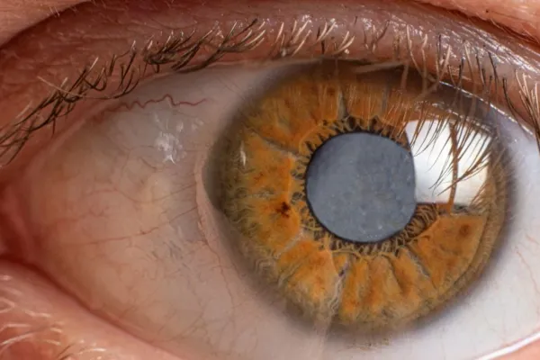 Protege tu visión: la diabetes aumenta el riesgo de glaucoma, la enfermedad silenciosa