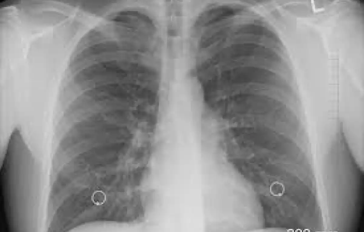 El cáncer de pulmón es la principal causa de muerte de esta enfermedad.