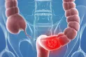 El cáncer de colon puede confundirse con esta enfermedad: ¿cuándo visitar al médico?