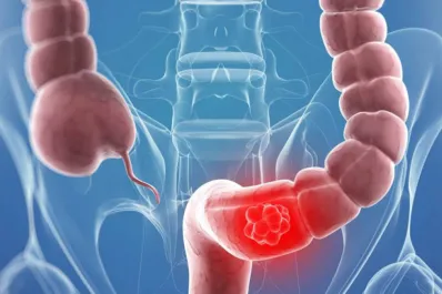 El cáncer de colon puede confundirse con esta enfermedad: ¿cuándo visitar al médico?