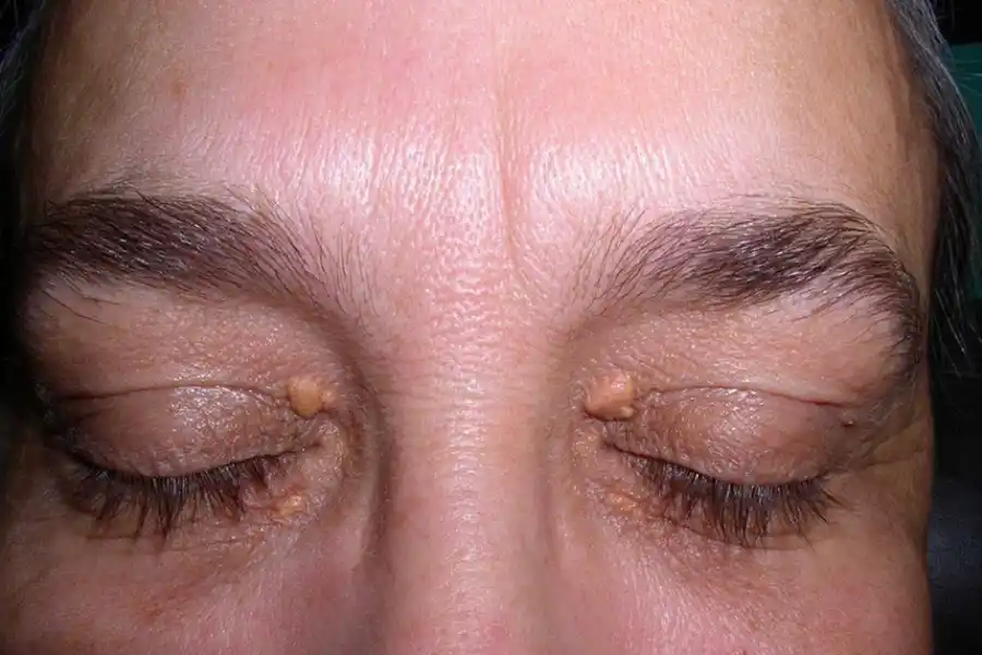 El xantoma se presenta en los párpados y puede ser un síntoma de colesterol alto.