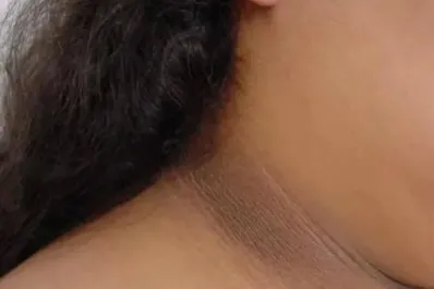 ¿Manchas oscuras en cuello, axilas o entrepierna? podría ser más que un problema estético