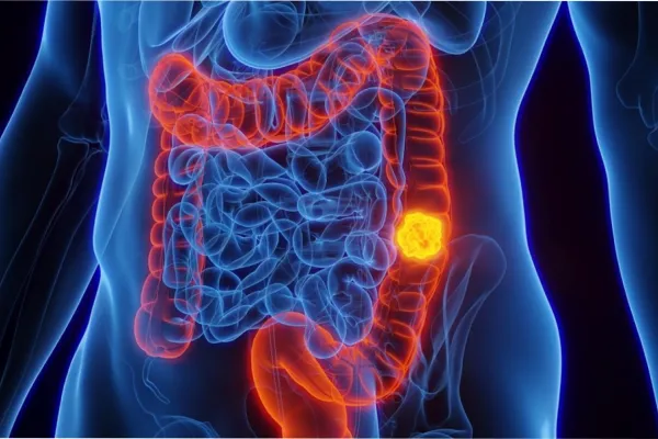 Comer un puñado de estos frutos secos puede reducir el riesgo de cáncer de colon