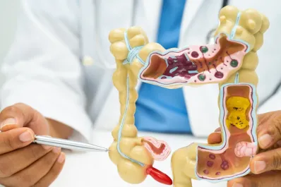 Detectar el cáncer de colon a tiempo: clave para la curación y reducción de mortalidad