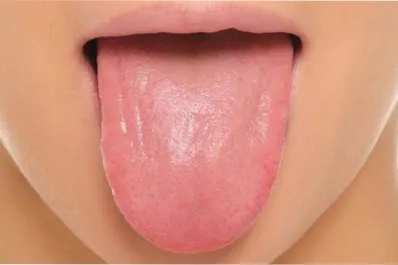 Cáncer de lengua: señales silenciosas que podrían confundirse con problemas menores