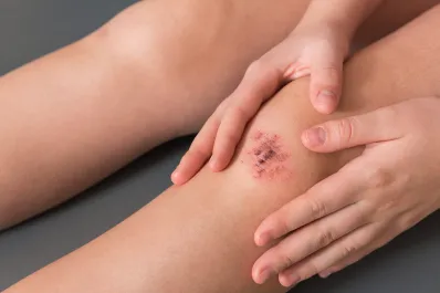 Cinco ingredientes naturales para estimular la cicatrización de la piel