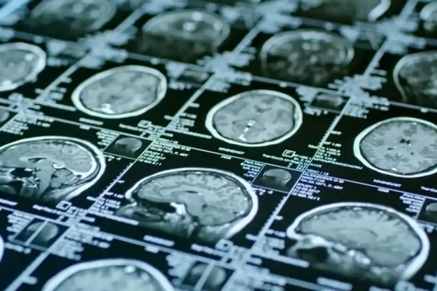 Cada cuatro minutos una vida cambia: la amenaza silenciosa del ACV