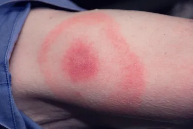 Cómo se contagia la enfermedad de Lyme: el diagnóstico que recibieron Justin Timberlake, Thalía y Justin Bieber