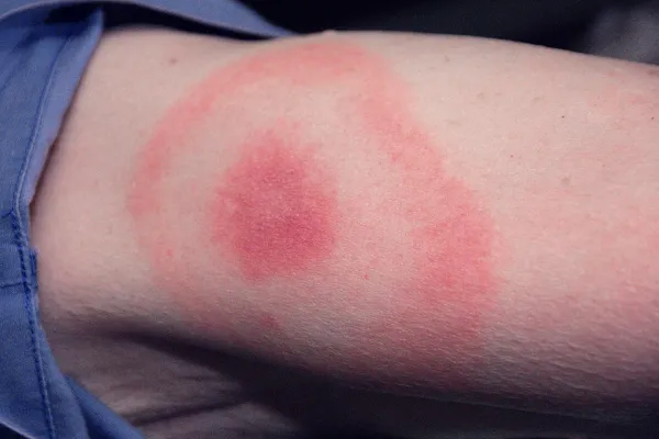 Cómo se contagia la enfermedad de Lyme: el diagnóstico que recibieron Justin Timberlake, Thalía y Justin Bieber