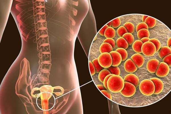 La gonorrea bate récord de contagios en España