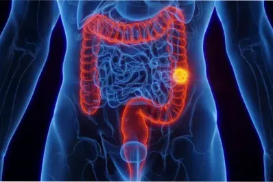 Cáncer de colon: estos son los síntomas silenciosos de la enfermedad
