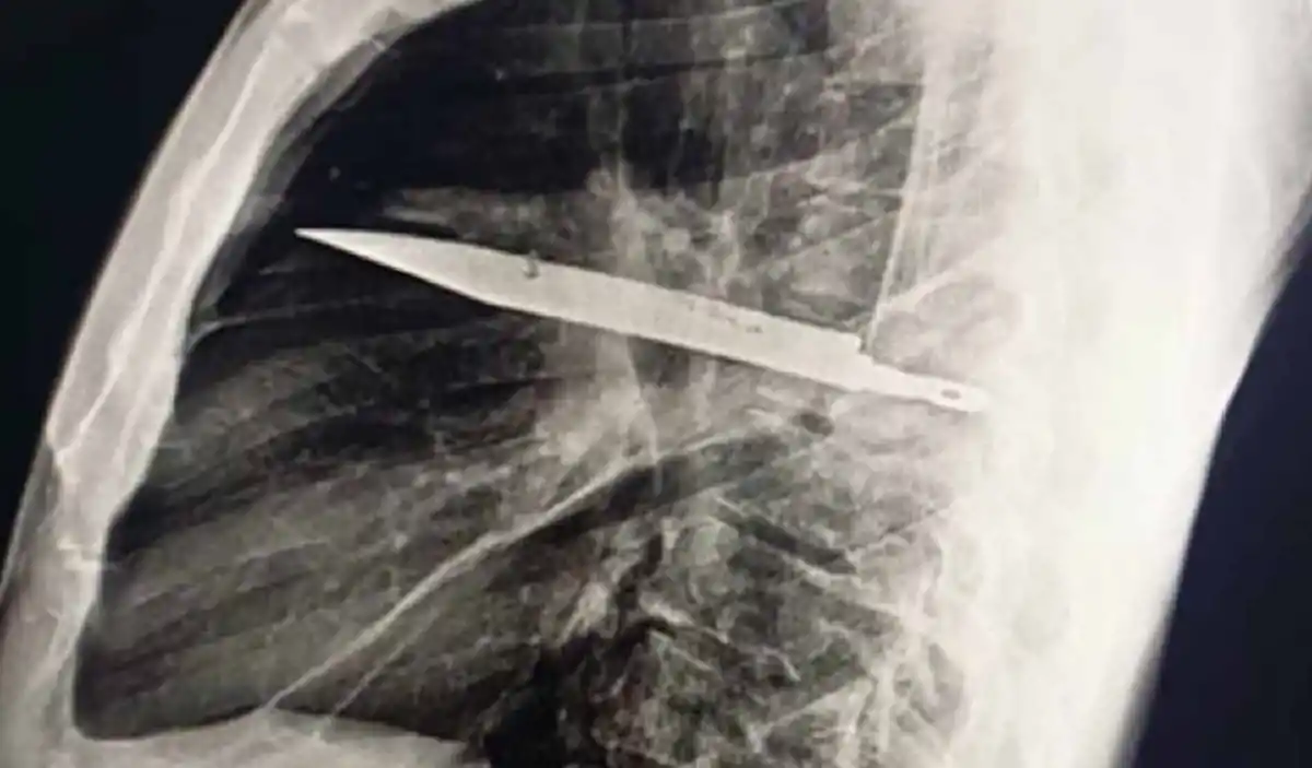 Impactante caso: un hombre llevó un cuchillo dentro del pecho durante casi una década