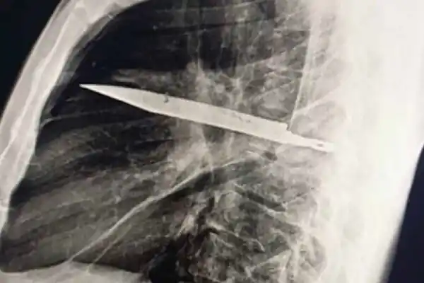 Impactante caso: un hombre llevó un cuchillo dentro del pecho durante casi una década