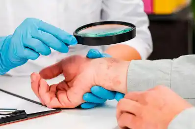 Campaña para detectar a tiempo la psoriasis