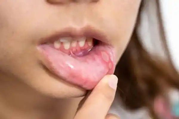 El síntoma que aparece en la boca y podría ser señal de un cáncer mortal, según un experto